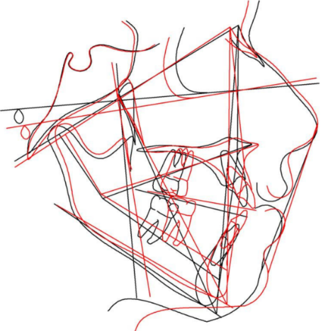 Cephalometric superimposition of pre and post treatment lateral cephalograms