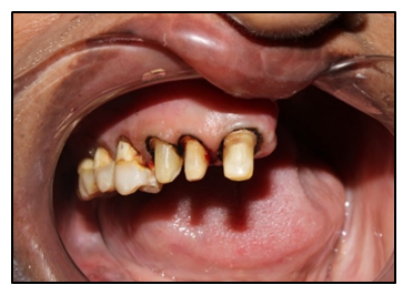 Teeth preparation and gingival retraction