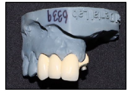 Glazed crowns with male component of semi precision attachment (Rhein 83)