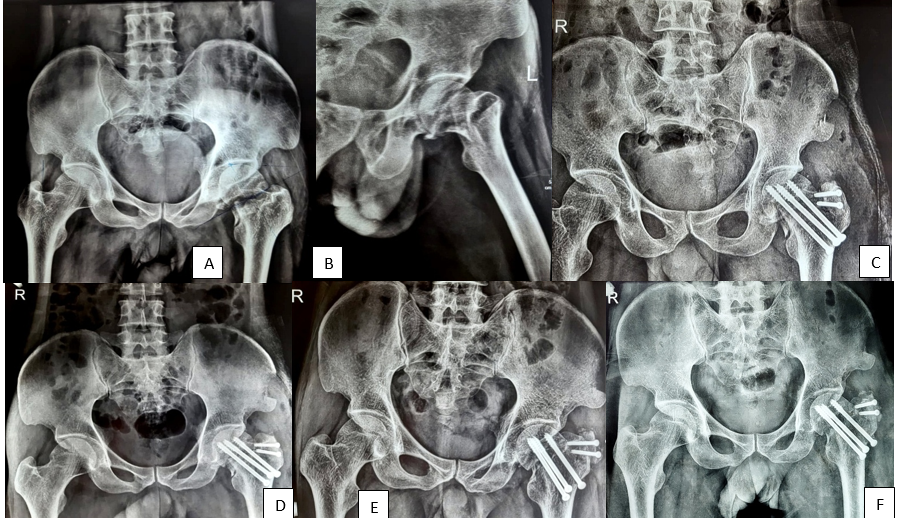 Case1, A): Pre-operative X ray AP view, Gardens Type III, B): Pre-operative X ray Lateral view, C): Post Op X ray AP view, D): Follow Up X ray AP view at 6 months, E): Follow Up X ray AP view at 1 year, F): Follow Up X ray AP view at 2 year