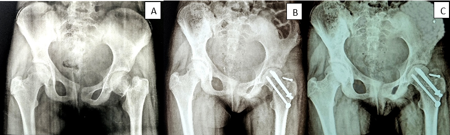 Case 2, A): Pre-operative X ray AP view, Gardens Type IV, B): Post Op X ray AP view, C): Follow Up X ray AP view at 2 year