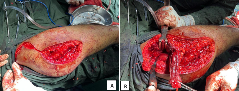 A): Intra op image showing incision mark, B): Intra op image showing bone graft harvest