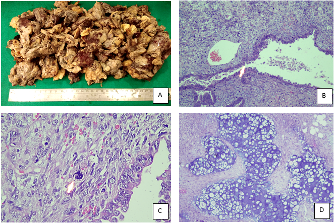 A: Multiple greyish brown friable, necrotic ovarian tissue pieces. B: Biphasic tumor involving epithelial and mesenchymal components (H&E; 200X). C: Atypical mitotic figure (H&E 400X). D: Focal Chondrosarcomatous component (H&E; 200X)