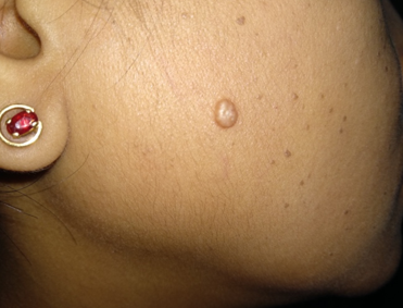 Skin coloured nodule with fine hair jutting out from a central pore at its summit.