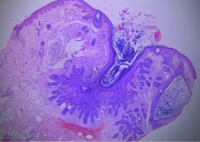 Multiple small immature and abortive hair follicles were seen radiating from the primary hair follicle (Scanner View – 4x)