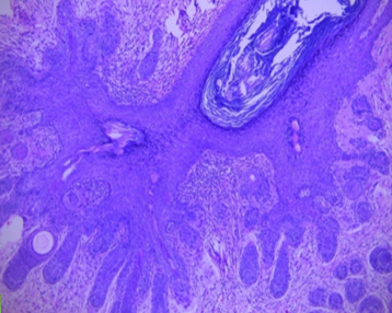 Multiple small immature and abortive hair follicles were seen radiating from the primary hair follicle (High Power – 10x)