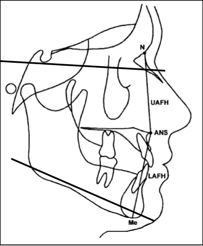 Landmarks: nasion (N), anterior nasal spine (ANS), and menton (Me). Linear distances: upper anteior face height (UAFH) and lower anterior face height (LAFH). Angular measurement: mandibular plane angle (Go-Gn-SN).