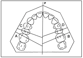 Occlusal view of maxillary dental study model. P, Maxillary midline; A, occlusal cut line for maxillary right molar; B, occlusal cut line for maxillary left molar; C, occlusal cut line for maxillary right premolar; D, occlusal cut line for maxillary left premolar.