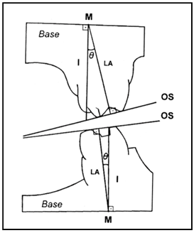 Anteroposterior view of both models. M, Inter- section of tooth long axis and dental study model base; LA, tooth long axis; I, line perpendicular to base of models. The angle represents relationship between tooth inclination and line perpendicular to base of model. Reproduced, withmodifications, from Ross et al.