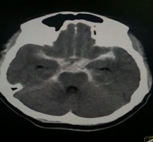 CT Brain plain showing Subarachnoid Hemorrhage in basal cistern