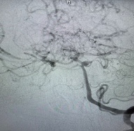 Cerebral angiography showing aneurysm at top of basilar artery.