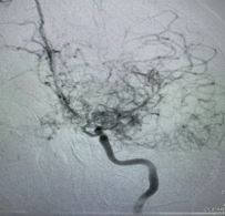 Cerebralangiograpgy showing stenosis at Internal carotid artery and multiple collaterals.