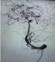 Post cerebral aneurysmembolisation of basilar artery.