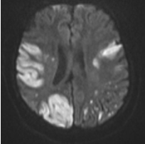 Diffusion weighted imageshowing multiple infract in bilateral temporal region, right occipital region and cortical infarcts.
