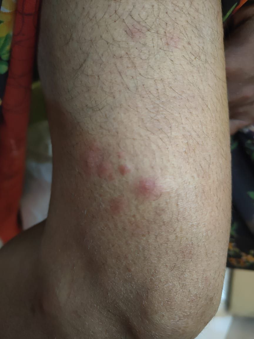Sweet syndrome like erythema nodosum leprosum