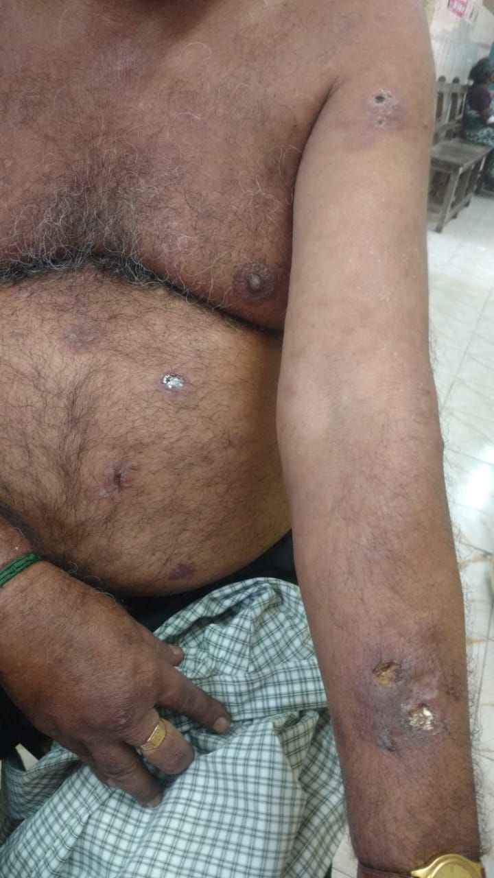 Erythema nodosum leprosum necroticans