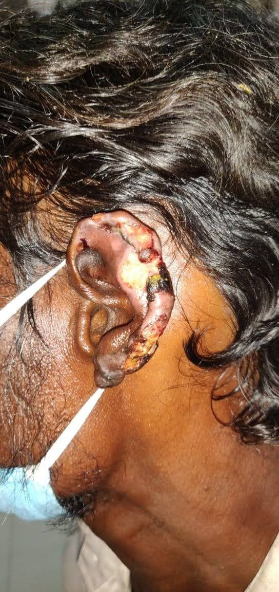Rat bitten appearance like enl