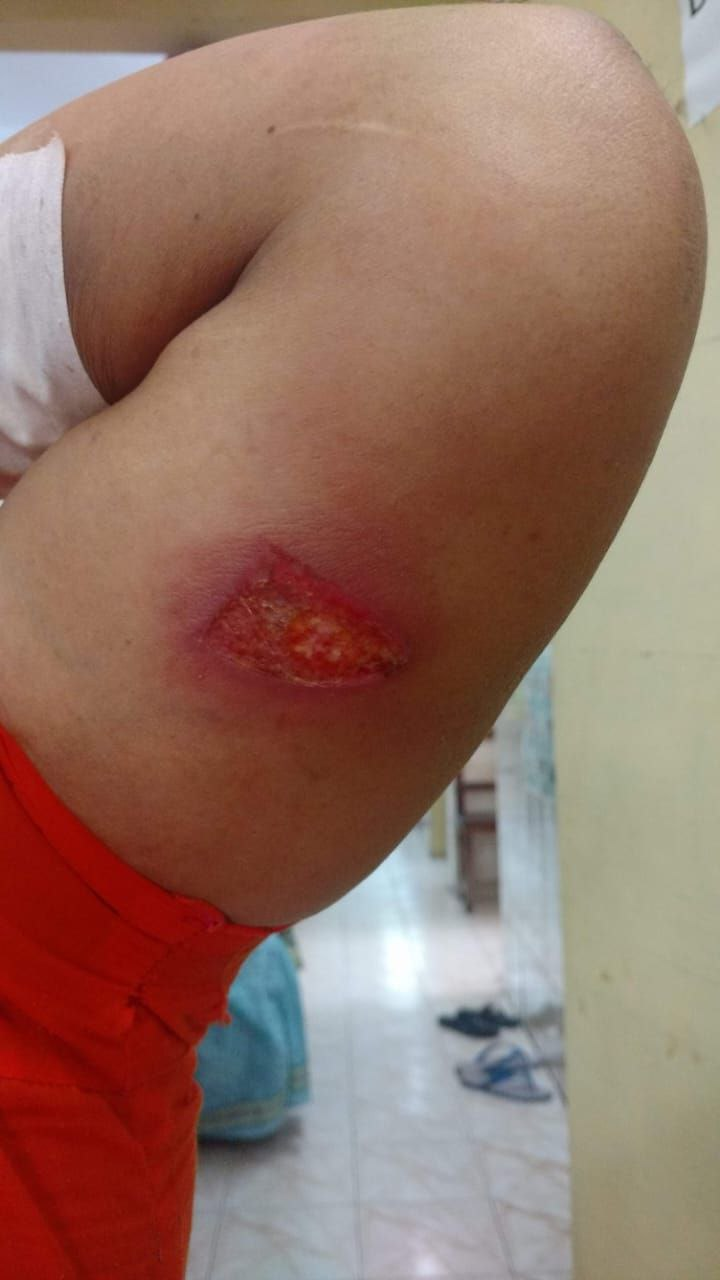 Erythema nodosum leprosum presenting as superficial ulceration