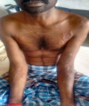 Type 1 Reaction with erythema nodosum leprosum