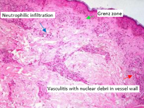 Histopathology of erythema nodosum leprosum