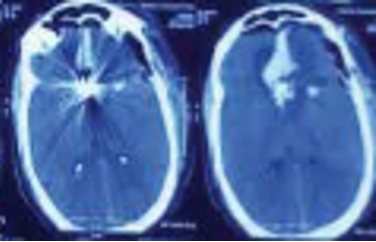CT scan of patient