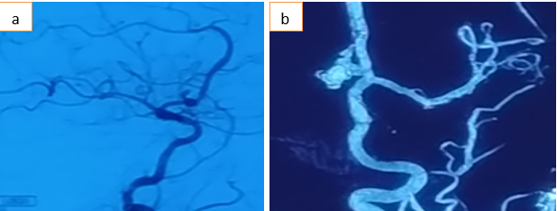 a and b: Cerebral DSA of patient