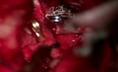 Intraoperative image