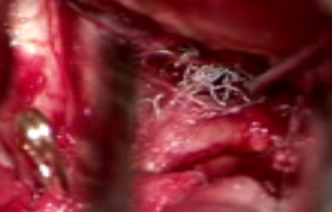 Intraoperative image
