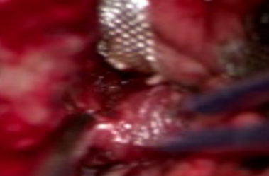 Intraoperative image