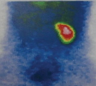 -DMSA scan showing left nonfunctional kidney