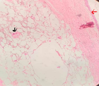 Histomorphology showing atrophy of renal parenchyma (red arrow) and replacement by mature adipose tissue. Sclerosed glomeruli is also seen (black arrow) [4x10]