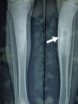Expansile osteolytic lesion at the upper diapysial region with associated surrounding dense rim of sclerotic changes.