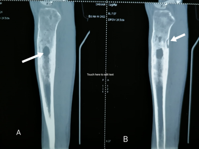 A&B: Coronal and saggital CT sections shows osteolytic lesion in the upper part of the tibial diaphysis with surrounding bony sclerotic changes, cortical thickening and periosteol reaction. Arrow shows a breach in the cortex at the posterior aspect of tibial diaphysis through which a serpentine fistulous tract seen extending from osteolytic lesion to the adjacent soft tissue.
