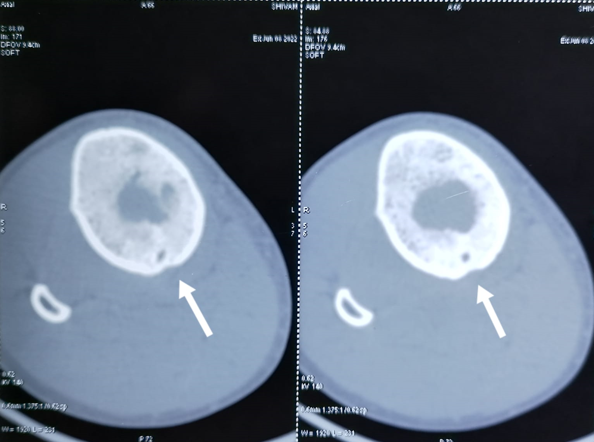 Axial CT sections shows osteolytic lesion in the upper part of the tibial diaphysis with surrounding bony sclerotic changes, cortical thickening and periosteol reaction with associated fistulous tract can be seen at the posterior aspect of tibial diaphysis.