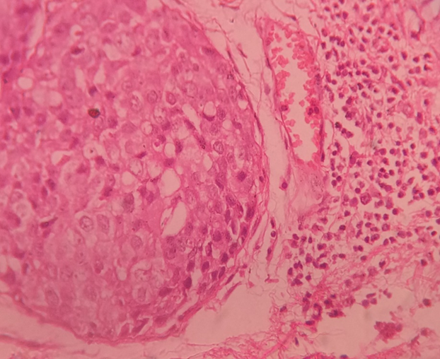 Photomicrograph showing Invasive Breast Carcinoma (H and E ×400)