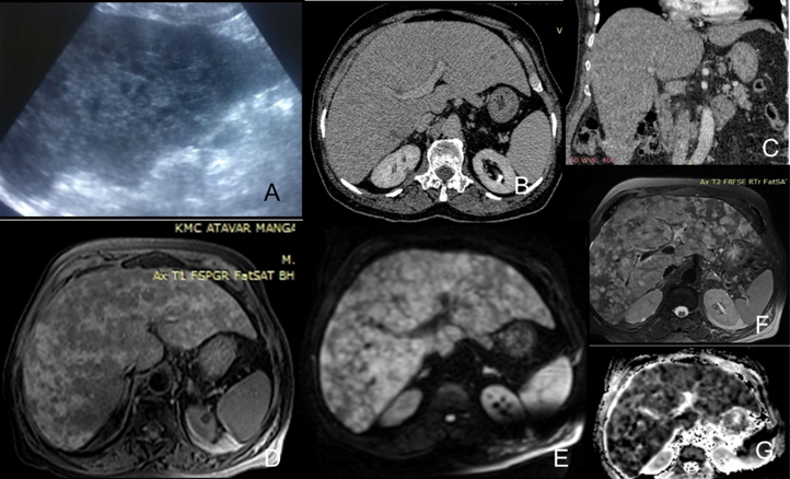 USG shows diffuse inhomogeneous echotexture of liver and tiny hypoechoic lesions with no posterior acoustic enhancement [A]: CT shows lesions in arterial and portal phase appeared hypoattenuating with no early contrast enhancement. Delayed contrast enhanced sections of liver showed persistent hypoattenuating nodules; [B,C]: MRI shows multiple ill-defined T2 iso to hyperintense nodules scattered diffusely in both lobes of liver; [D]: The nodules showed significant diffusion restriction; [E] and appeared T1 hypointense; [F]: The MRI appearance in the DWI and ADC sequence was similar to the ‘starry sky pattern’ [G]