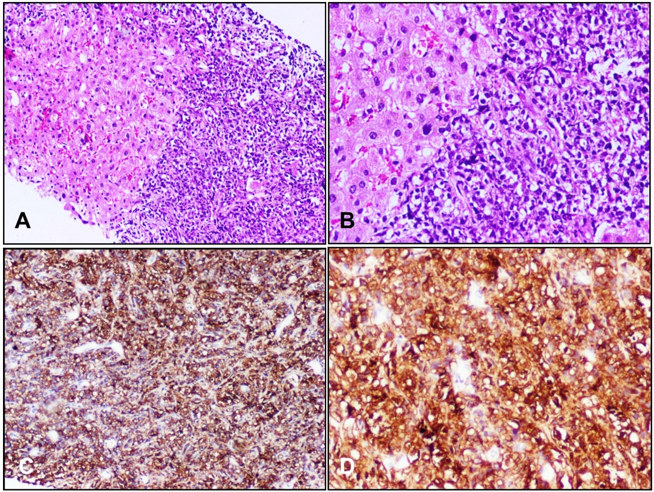 (H&E, 100x)Histopathological evaluation shows the core of liver tissue showing infiltrating sheets of neoplastic cells; (A): (H&E, 200x) Neoplastic cells have moderate amount of cytoplasm, pleomorphic hyperchromatic nuclei with high N/C ratio; (B): (LCA, 100x) Immunohistochemistry (IHC) studies showing neoplastic cells positive for LCA (C). (CD20, 200x) Neoplastic cells positive for CD20 (D).