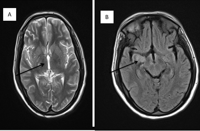 A: MRI barin showing T2 hyperintensity of right thalamus; B: MRI barin showing T2 flair hyperintensity of right temporal lobe.