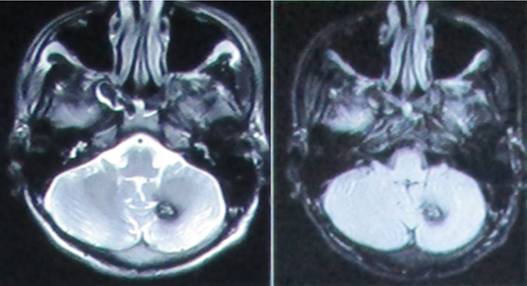 MRI brain showing hemmorhage in left cerebellar lobe.