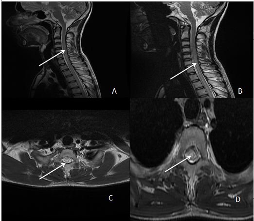 MRI cervical and dorsal spine; A,B: (coronal)- T2 hyperintensity of cord from C4 to T1; C,D: (axial)- T2 hyperintensity in cerical spine.