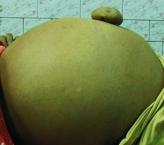 Showing hugely distended abdomen with the umbilical hernia