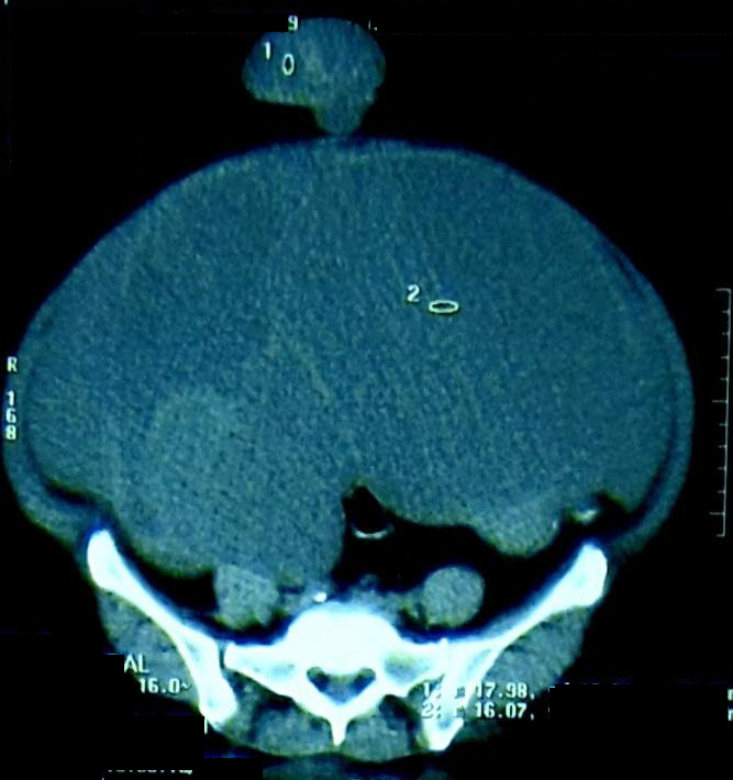 CT scan image showing the tumor mass with a part of it protruding through the umbilicus