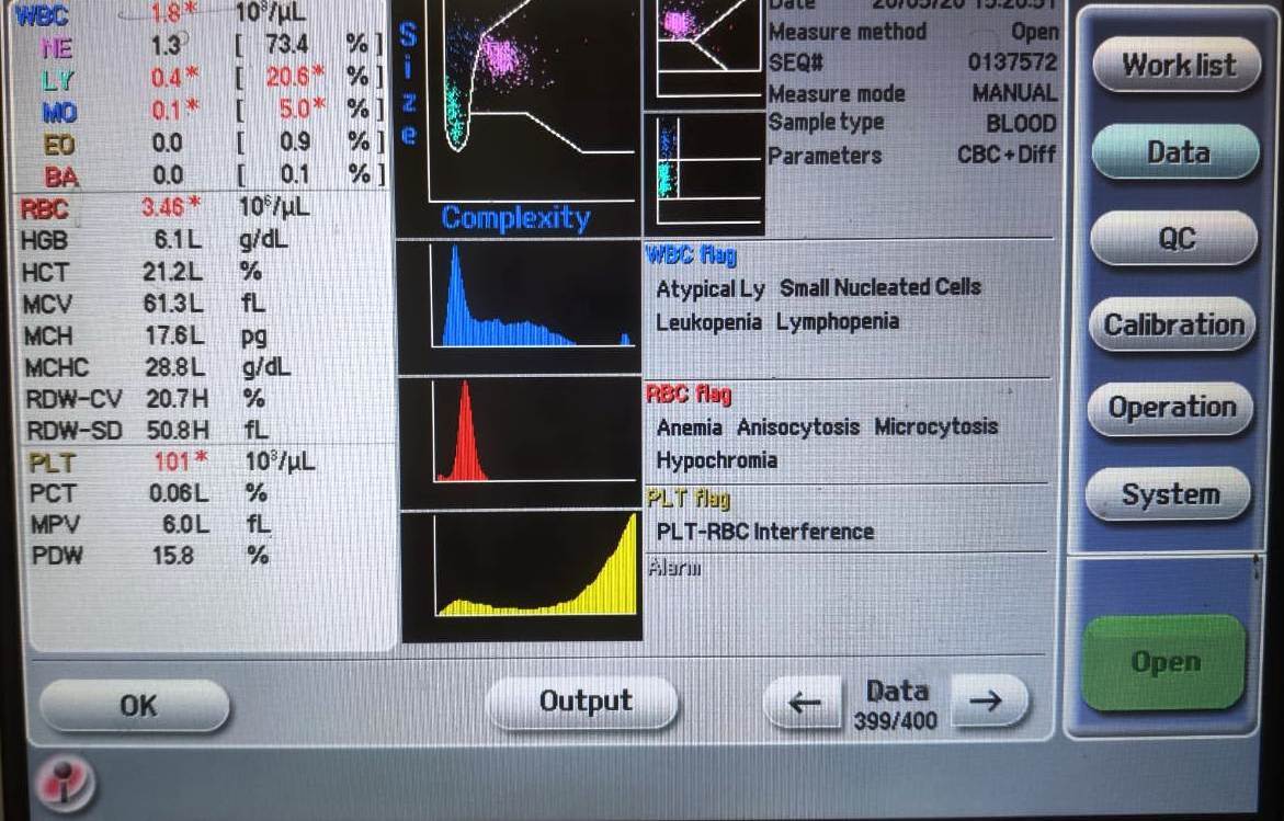 Microcytosis: Shift to left