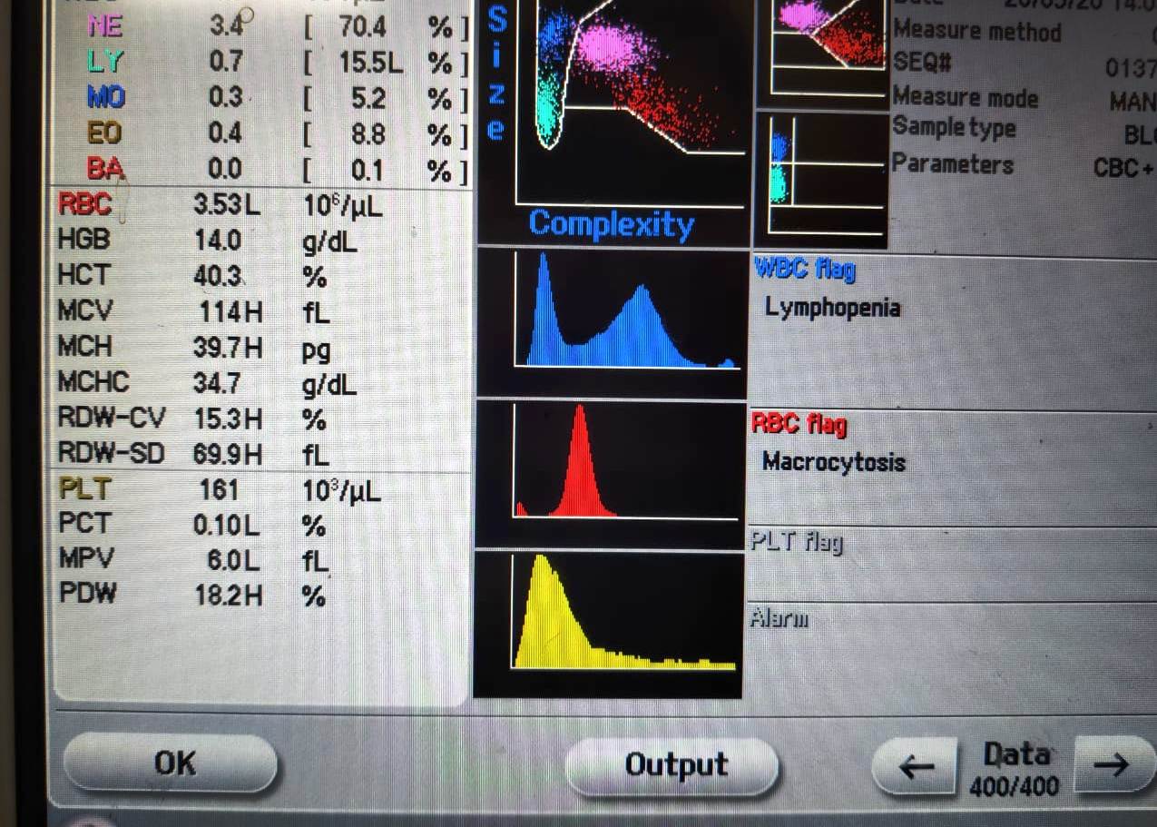Macrocytosis; Shift to right