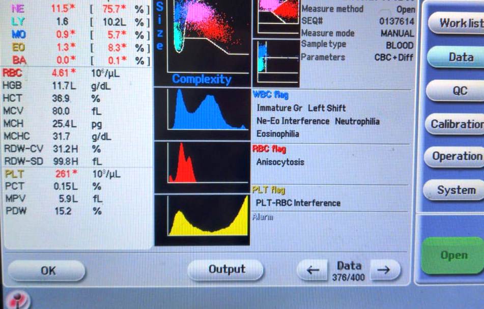 Dimorphic anemia: Double peak