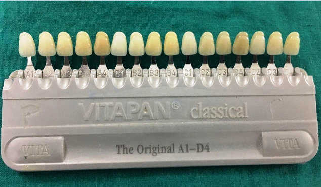 Vitapan classical shade guide.