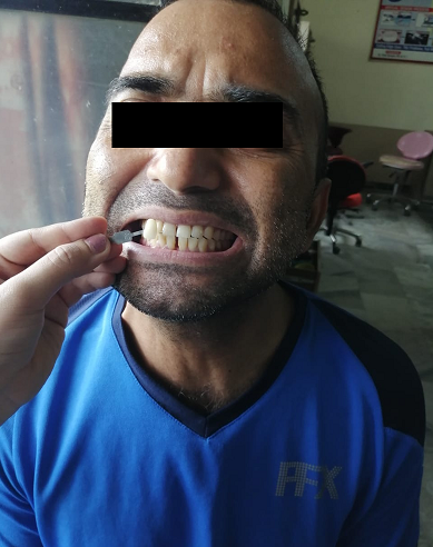 Photograph gauging the toothcolor in comparison with the patient using Vitapan shade guide under natural light.