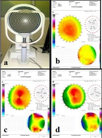 Corneal topography. a: Placido disc based corneal topographer PCT-200 by Optopol and; b,c,d: Topography maps showing round, symmetric bow tie and asymmetric bow tie patterns respectively.