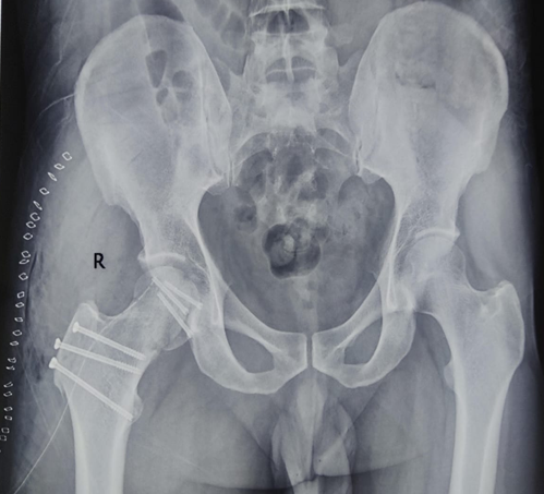 Post operative x-ray