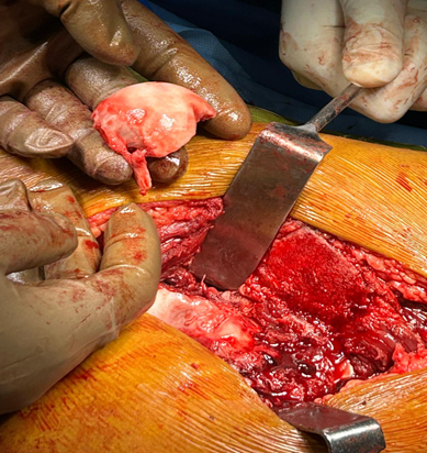 Intraoperative picture showing femoral head fracture